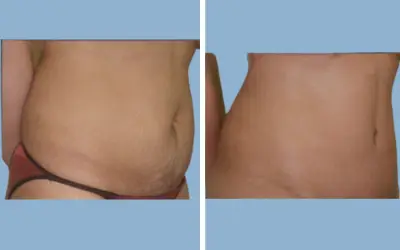 Before and After